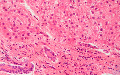 Diabetes mellitus en pacientes con cirrosis hepática